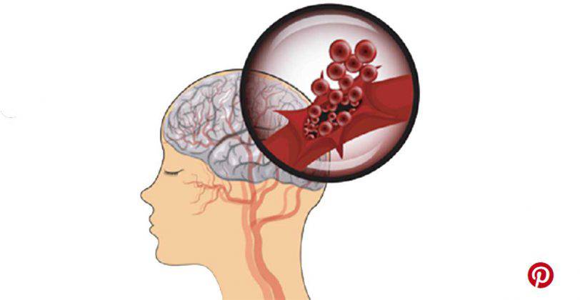 Emorragia cerebrale, sintomi e fattori di rischio dell'ictus