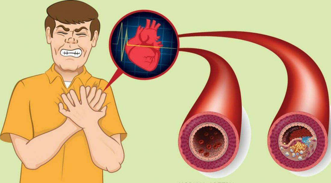 9 alimenti che puliscono le arterie e prevengono l'infarto