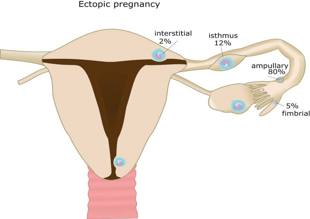 Gravidanza Ectopica O Extrauterina Cosa Sintomi E Terapie