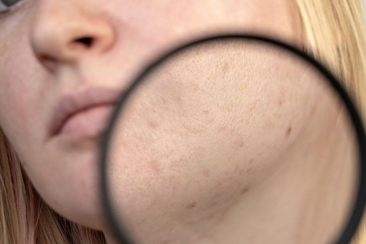 Donna con evidenti segni di acne sul viso