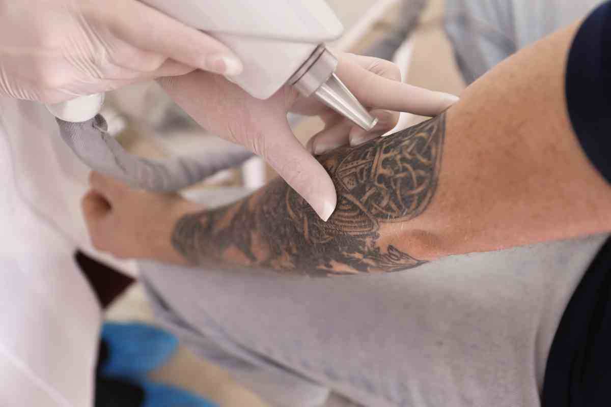 come si effettua la rimozione del tatuaggio 